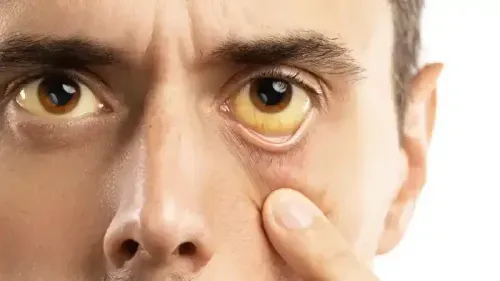 How is Jaundice Detected?